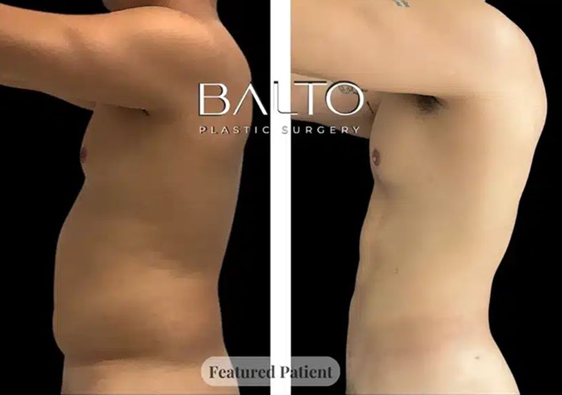 Male Liposuction Before & After