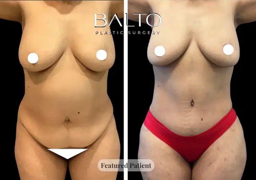 Tummy Tuck Before & After