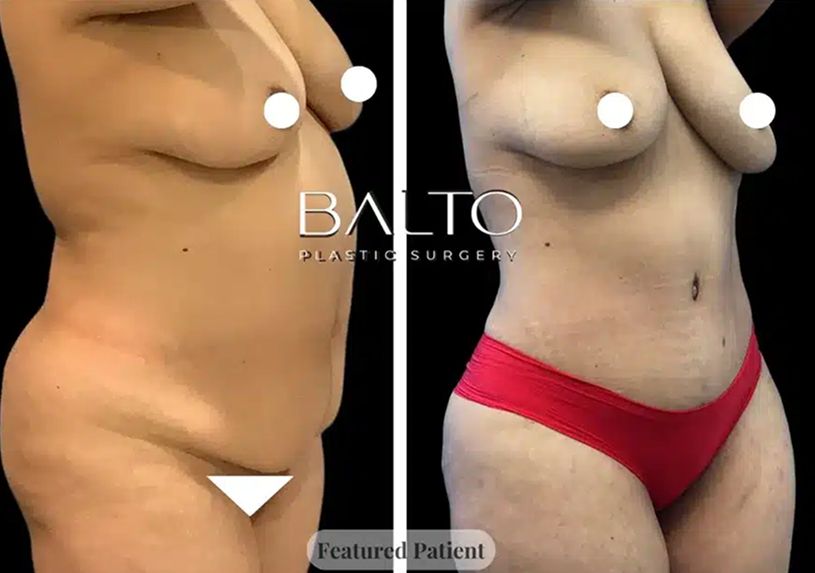 Tummy Tuck Before & After