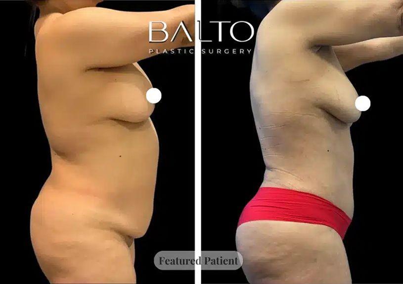 Tummy Tuck Before & After