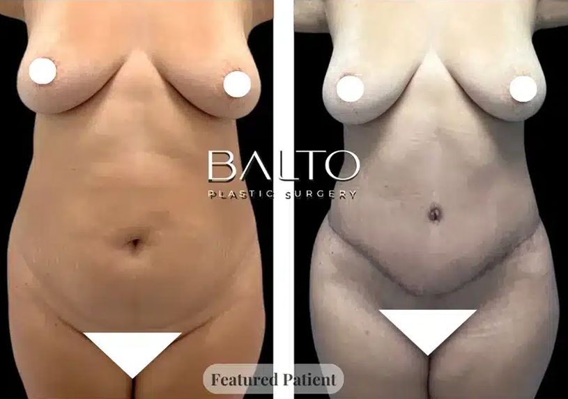 Tummy Tuck Before & After