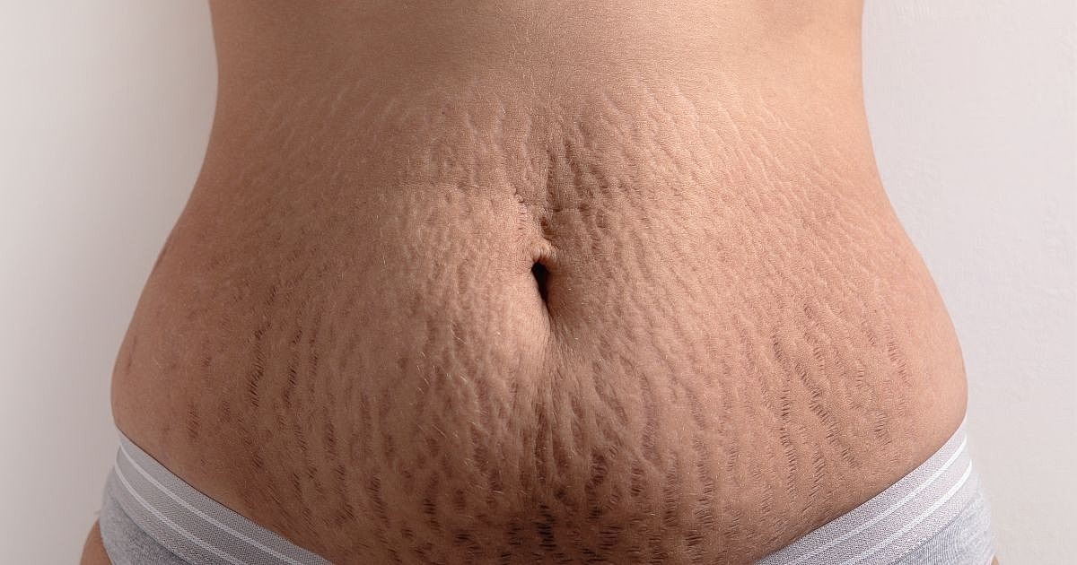 5 Ways Microneedling Can Improve Stretch Marks