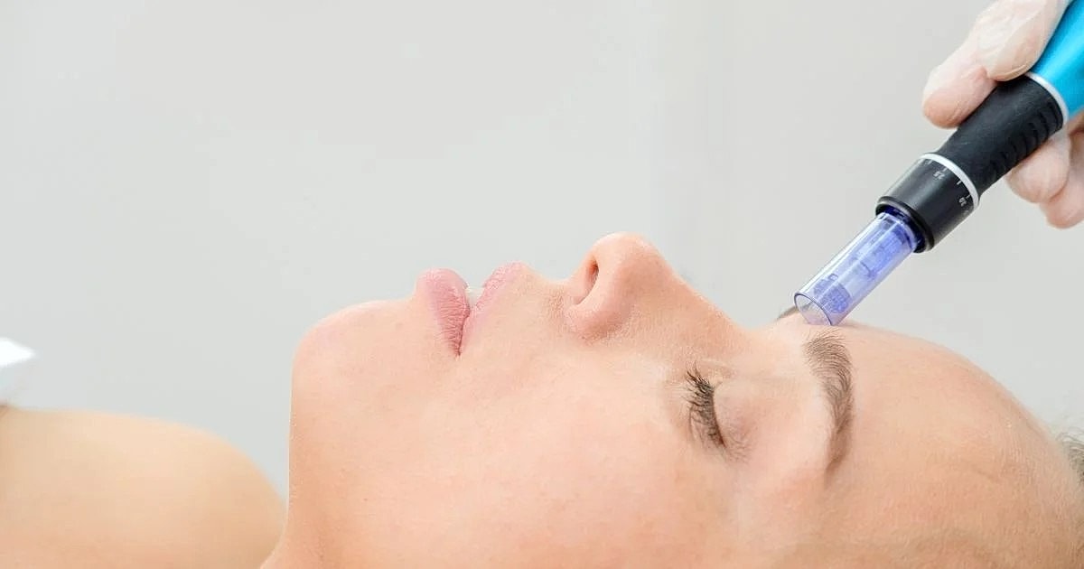5 Ways Microneedling Can Improve Stretch Marks