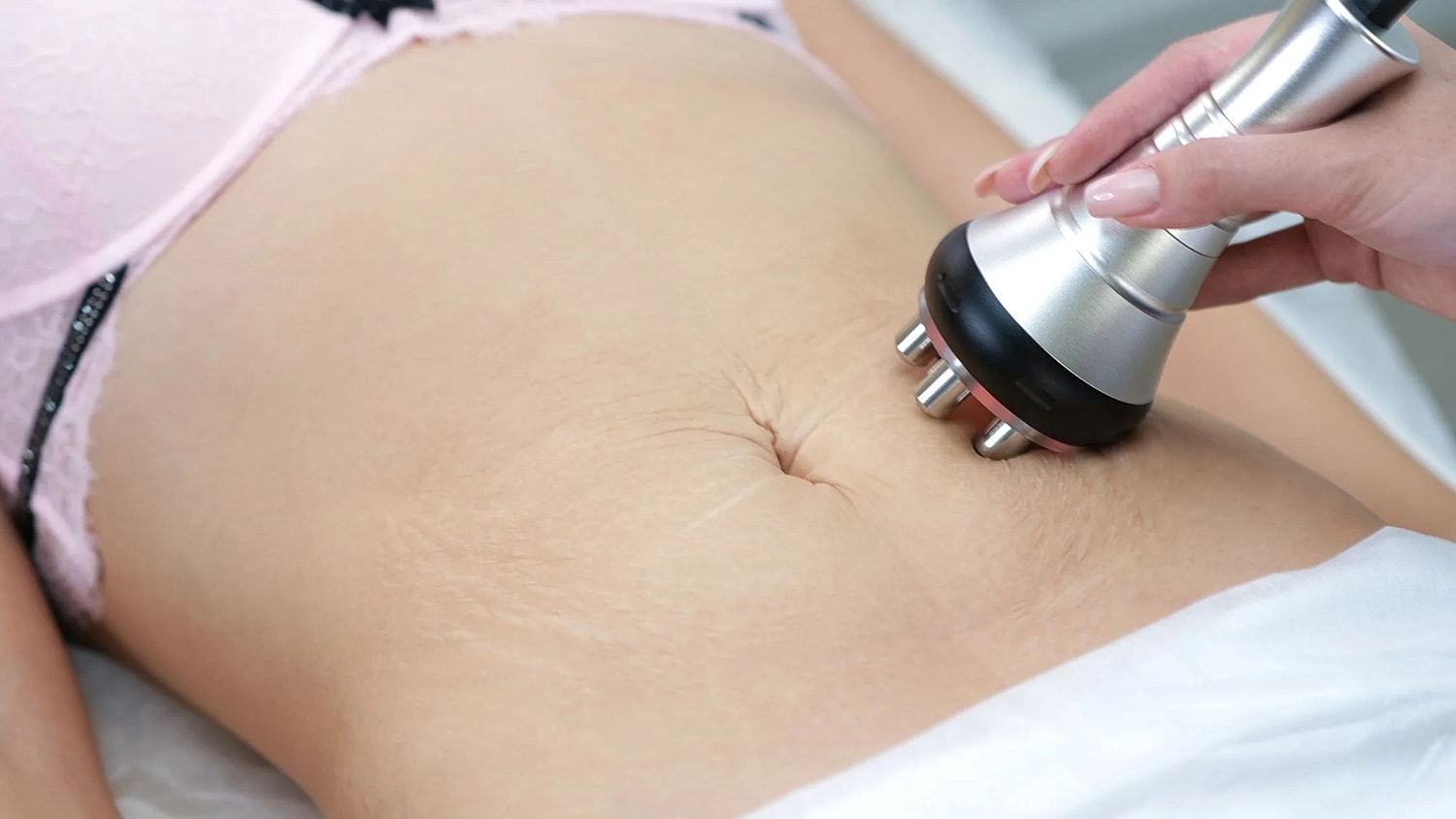 6 Ways Microneedling Remarkably Transforms Stretch Marks