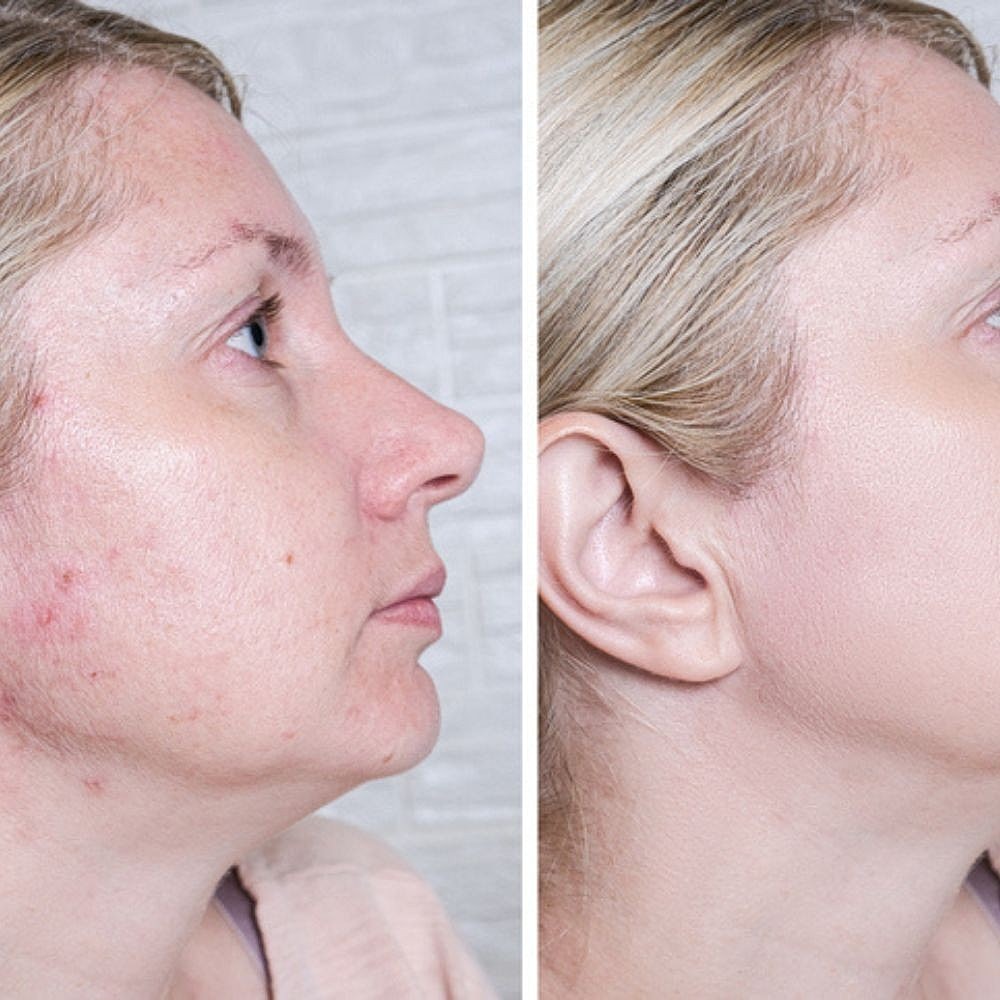 Acne Treatment