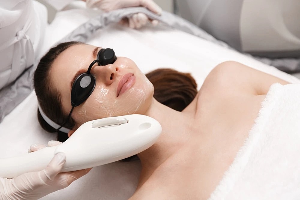 Woman receiving BBL treatment for rosacea skin concerns.