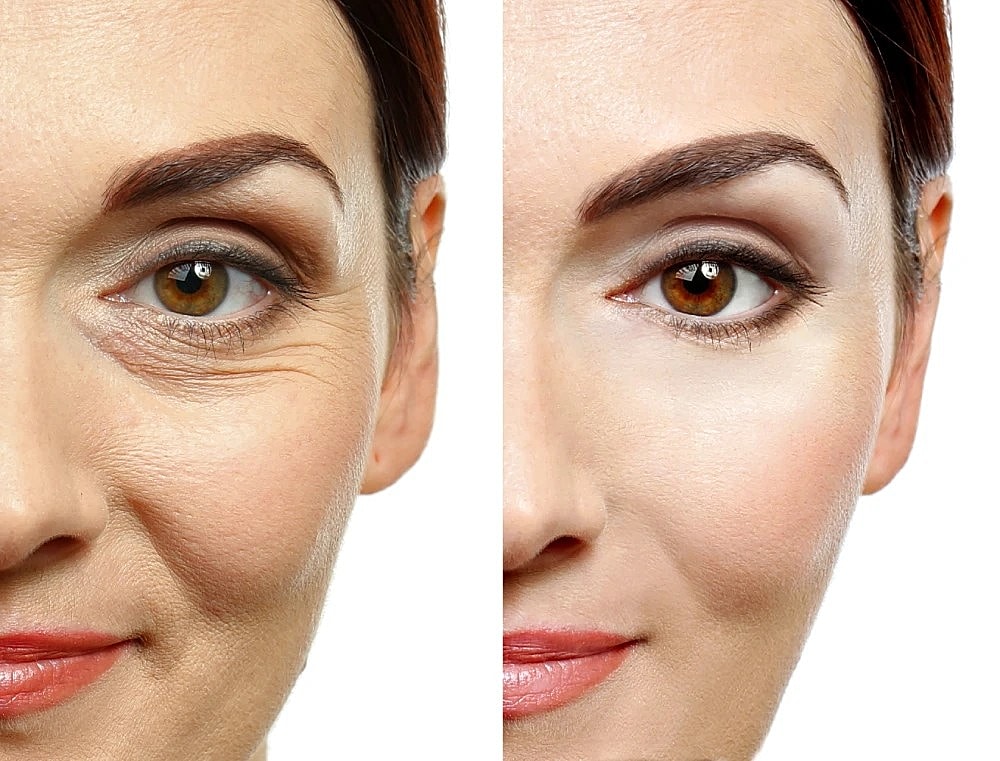 Close-up before and after of a woman’s eye area showing Botox wrinkle reduction.