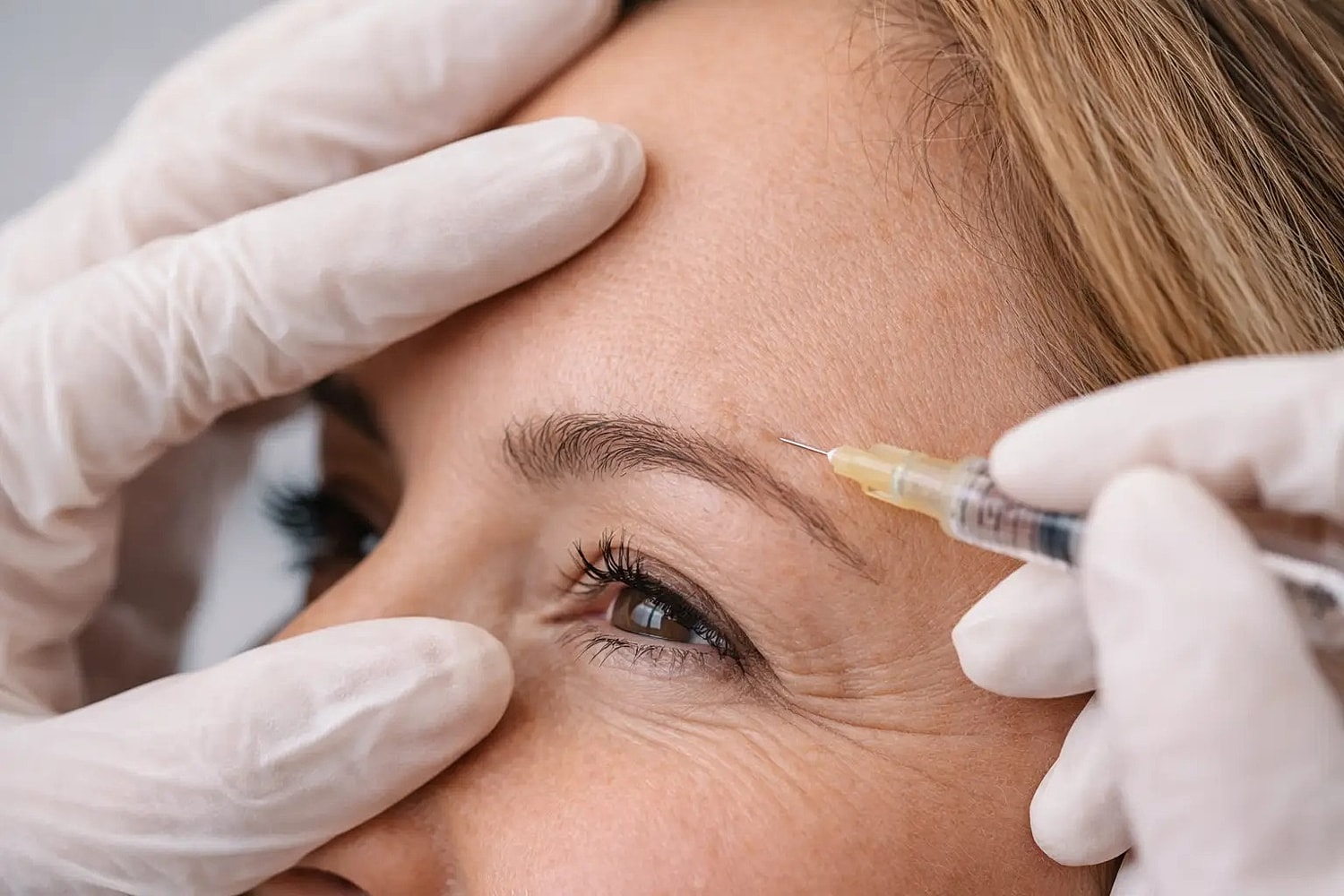 Close-up of a syringe injecting near the forehead while gloved hands gently hold the skin