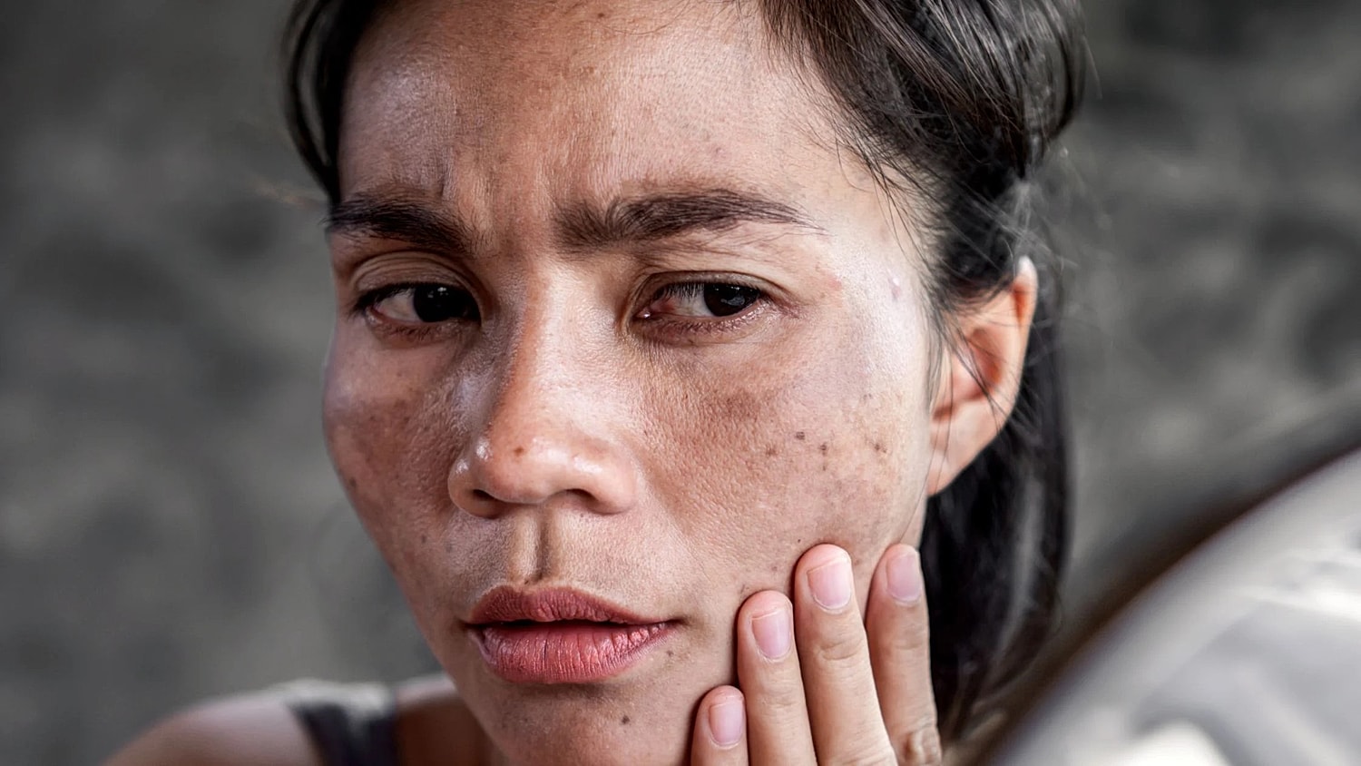 Chemical Peels Can They Effectively Treat Melasma?