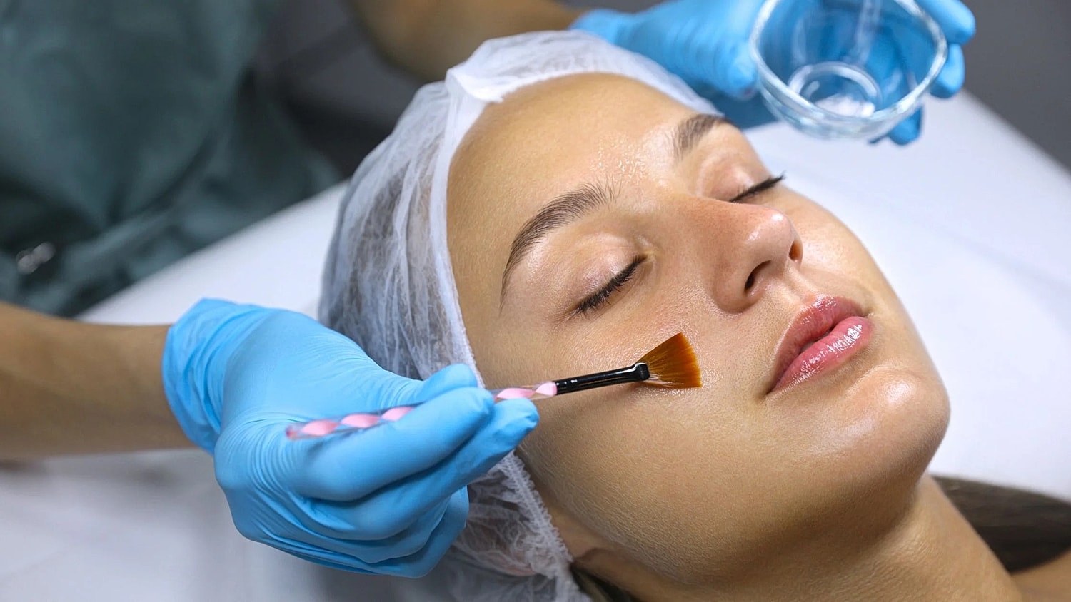 Chemical Peels Can They Effectively Treat Melasma?