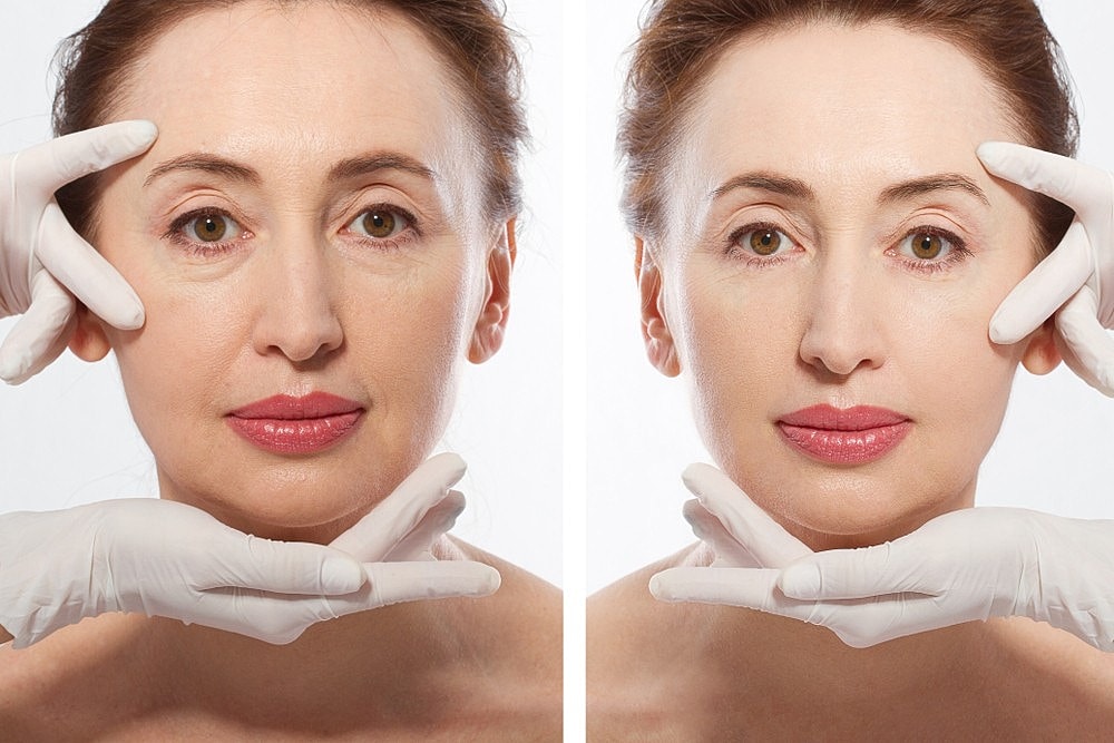 Choosing the Right Dermal Filler: Factors to Consider