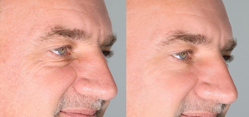 Close-up of man’s face before and after wrinkle treatment with cosmetic dermatology.