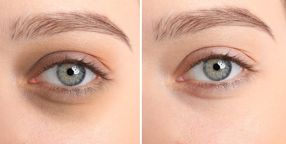 Before and after results of under-eye dermal fillers treatment.