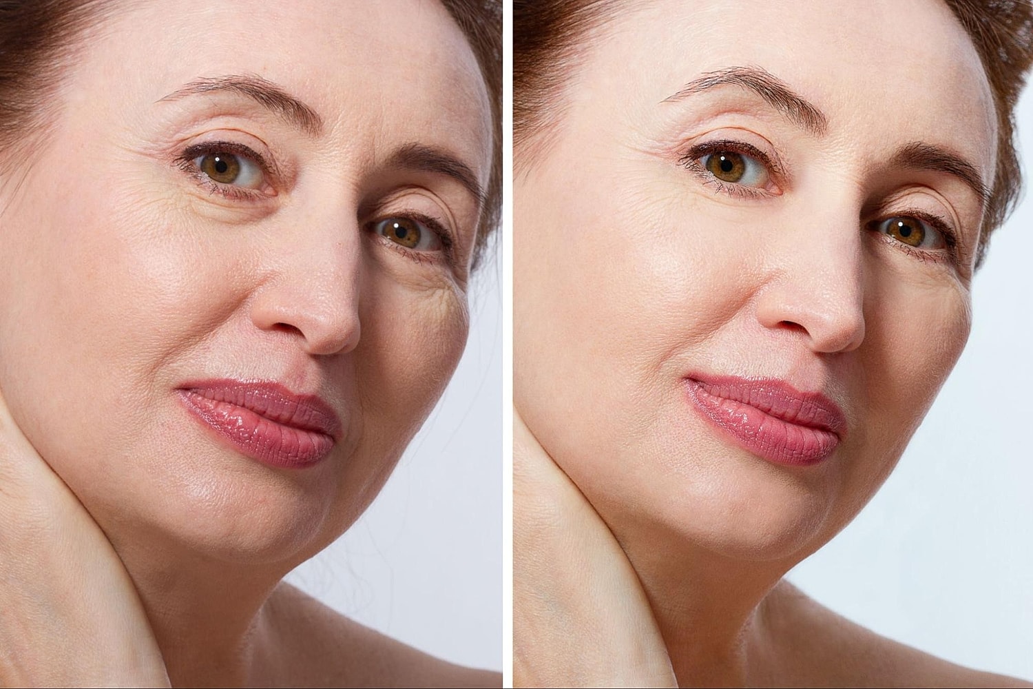 Exploring Other Options Like Botox: Learning About Xeomin and Dysport in Simple Terms