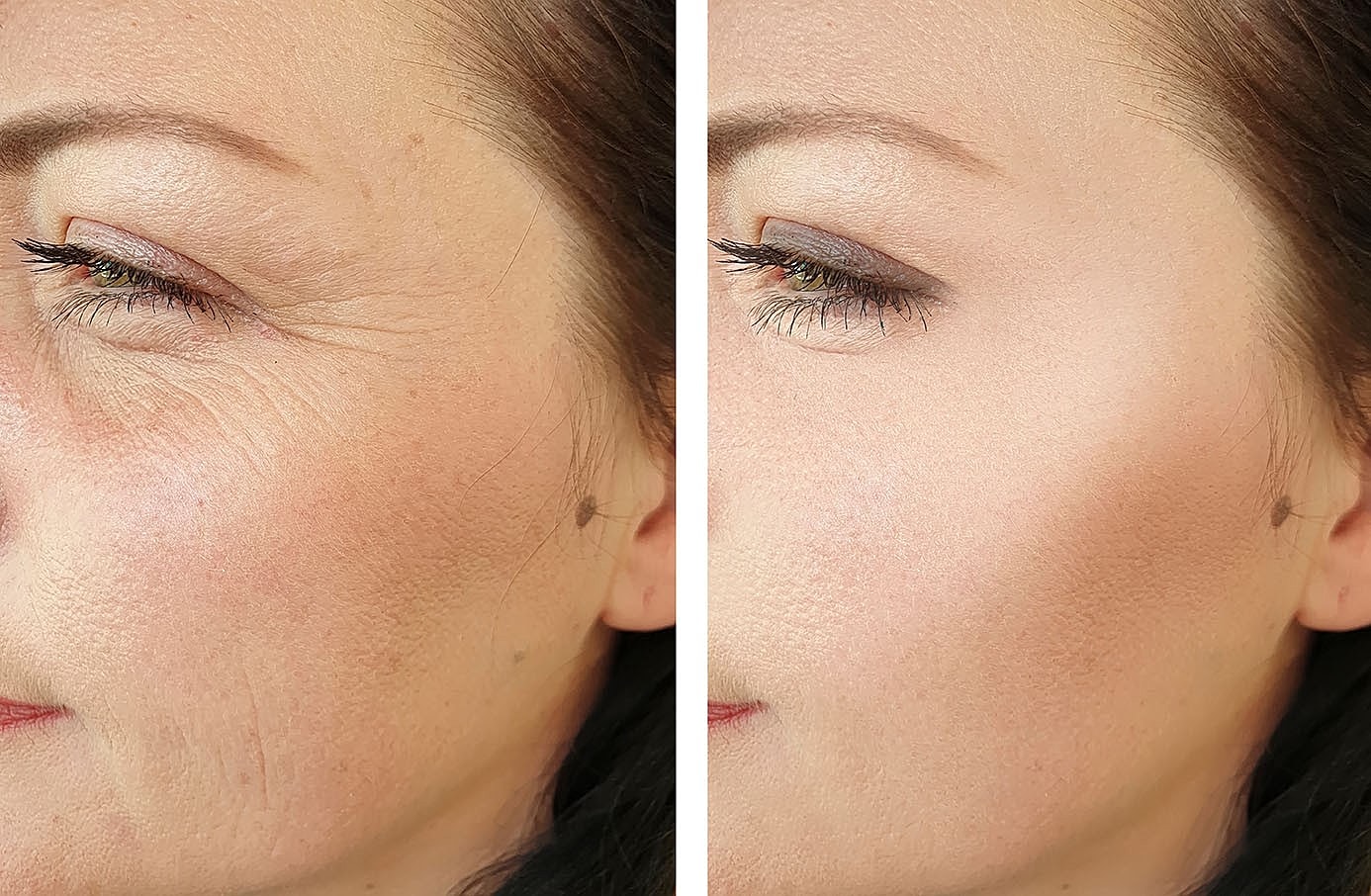 Before and after comparison of wrinkles reduced by RF microneedling.