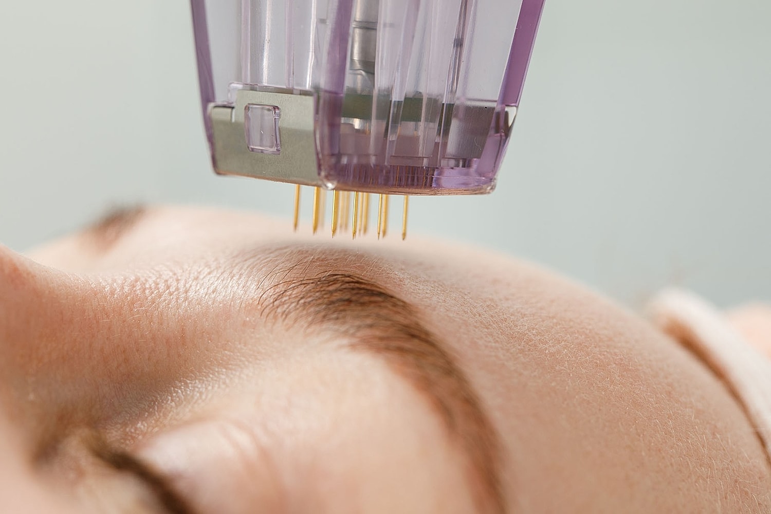RF microneedling device in action on facial skin.