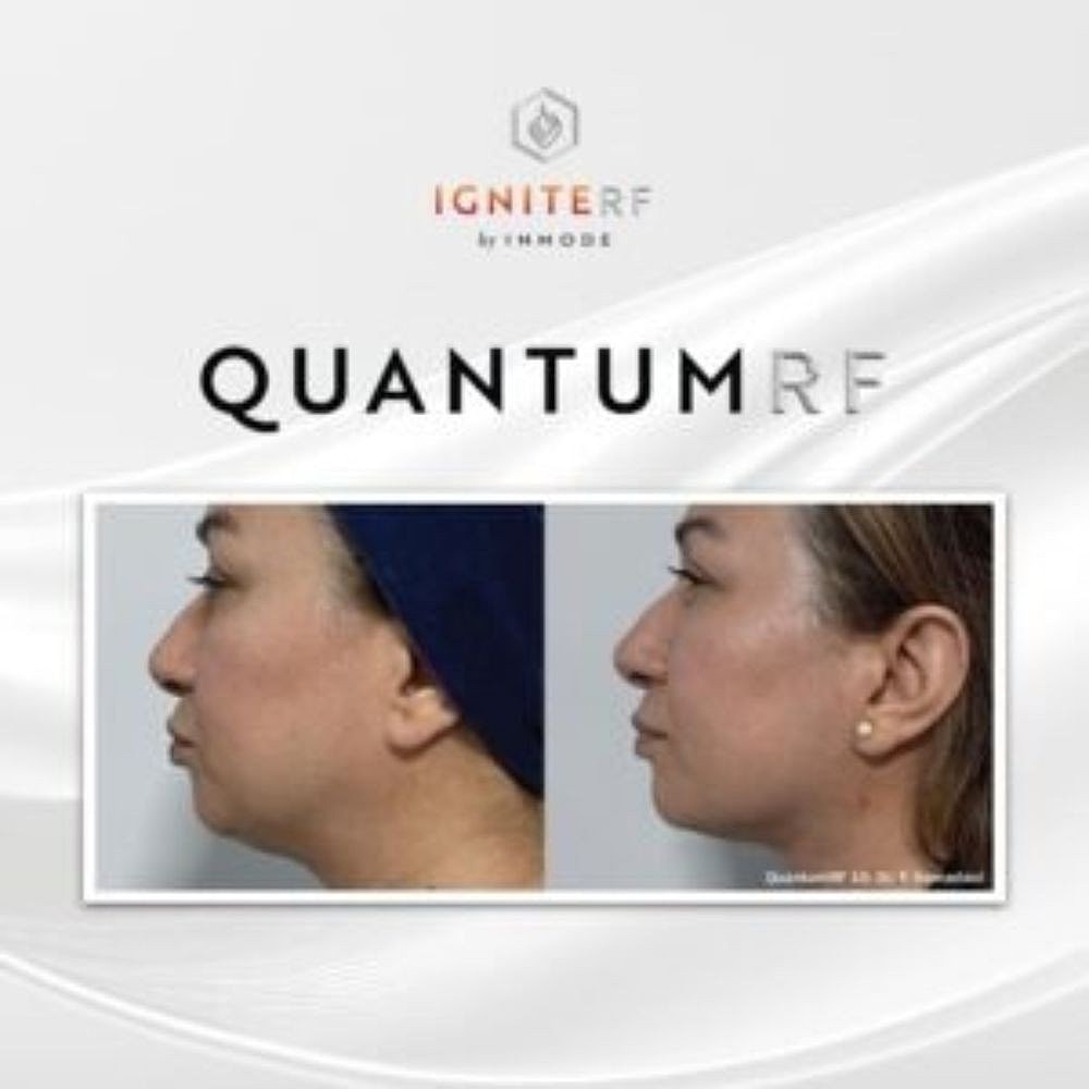 BA Quantum RF 10-4