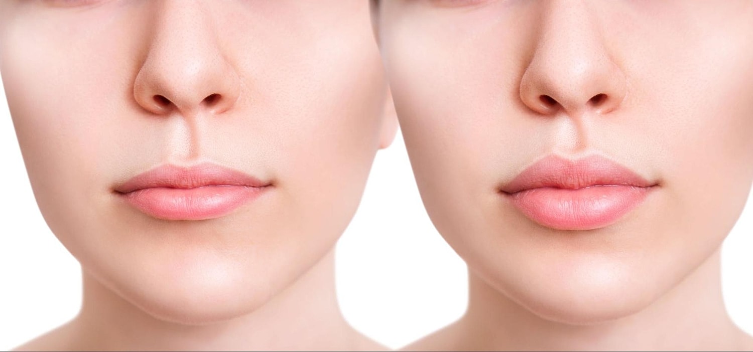 Lip Filler Treatment Timeline: Managing Expectations and Results - Image 2