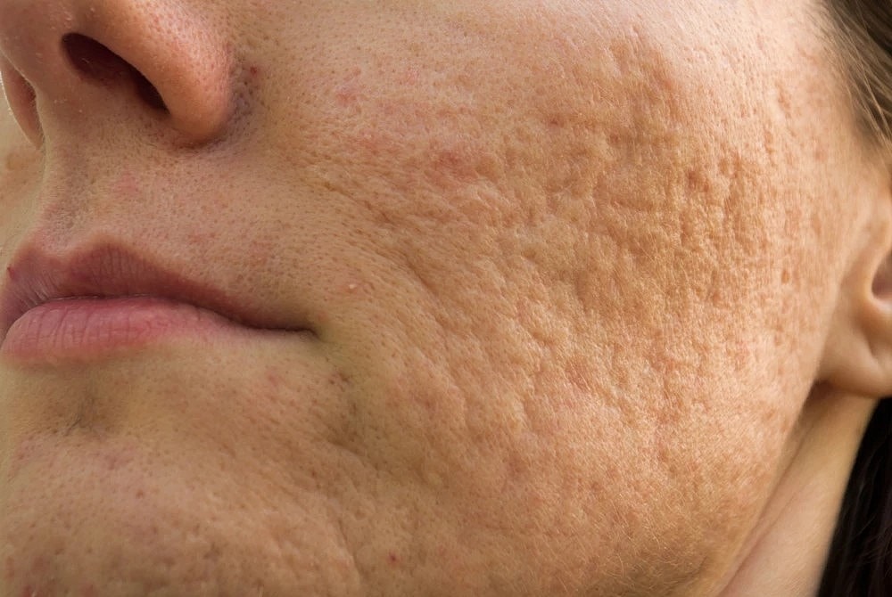 Close-up of acne scarring treated with Morpheus8.