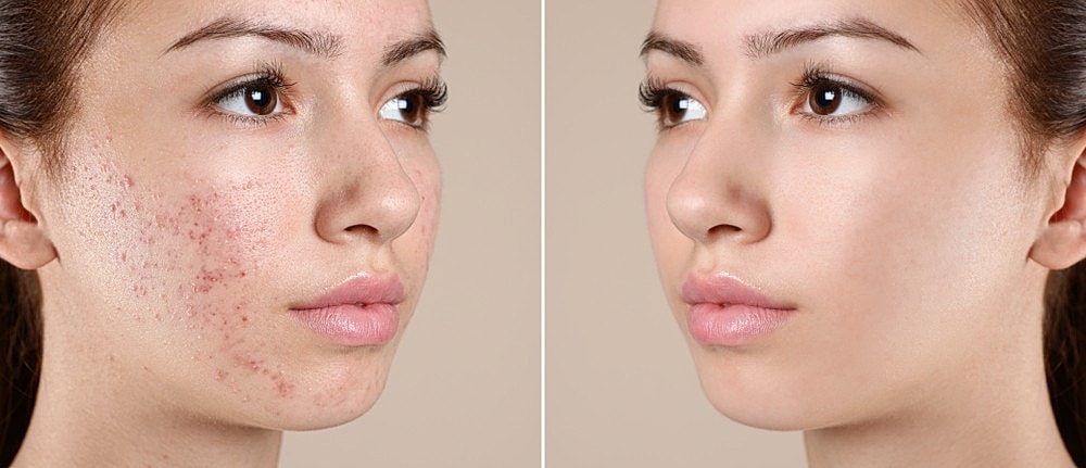 Morpheus8: Navigating the Timeline of Radiant Skin Renewal