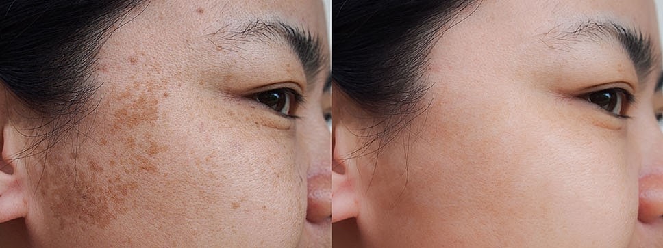 Before and after results of sun damage treated with Moxi.