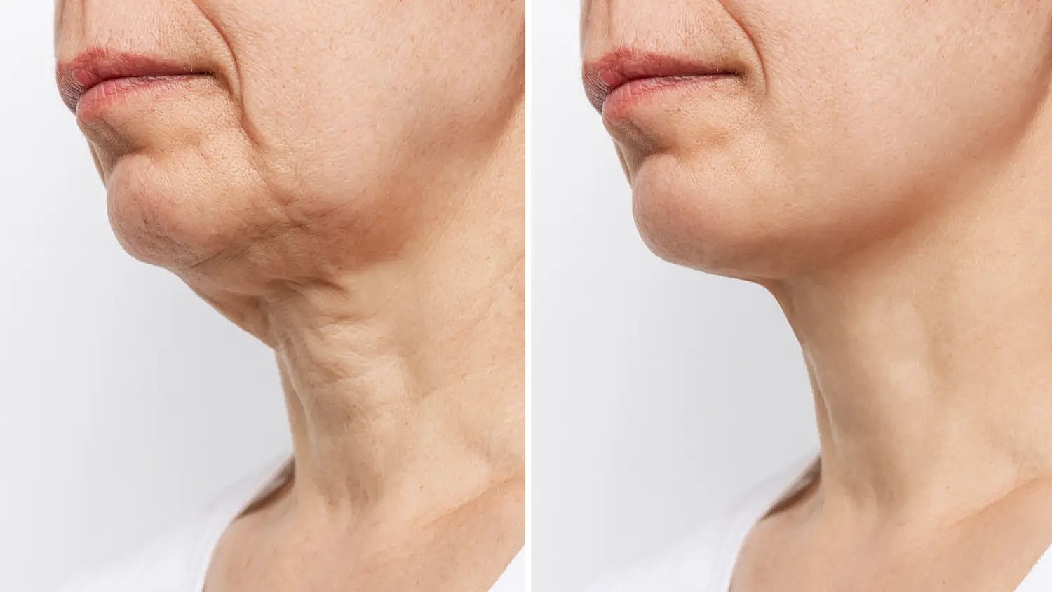 before and after comparison of sagging neck skin improved after treatment
