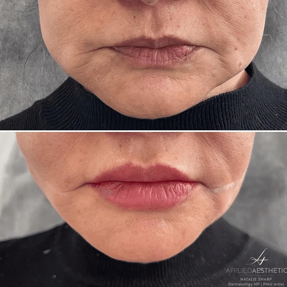 PDO Thread Lift Aftercare: Essential Tips for Optimal Results