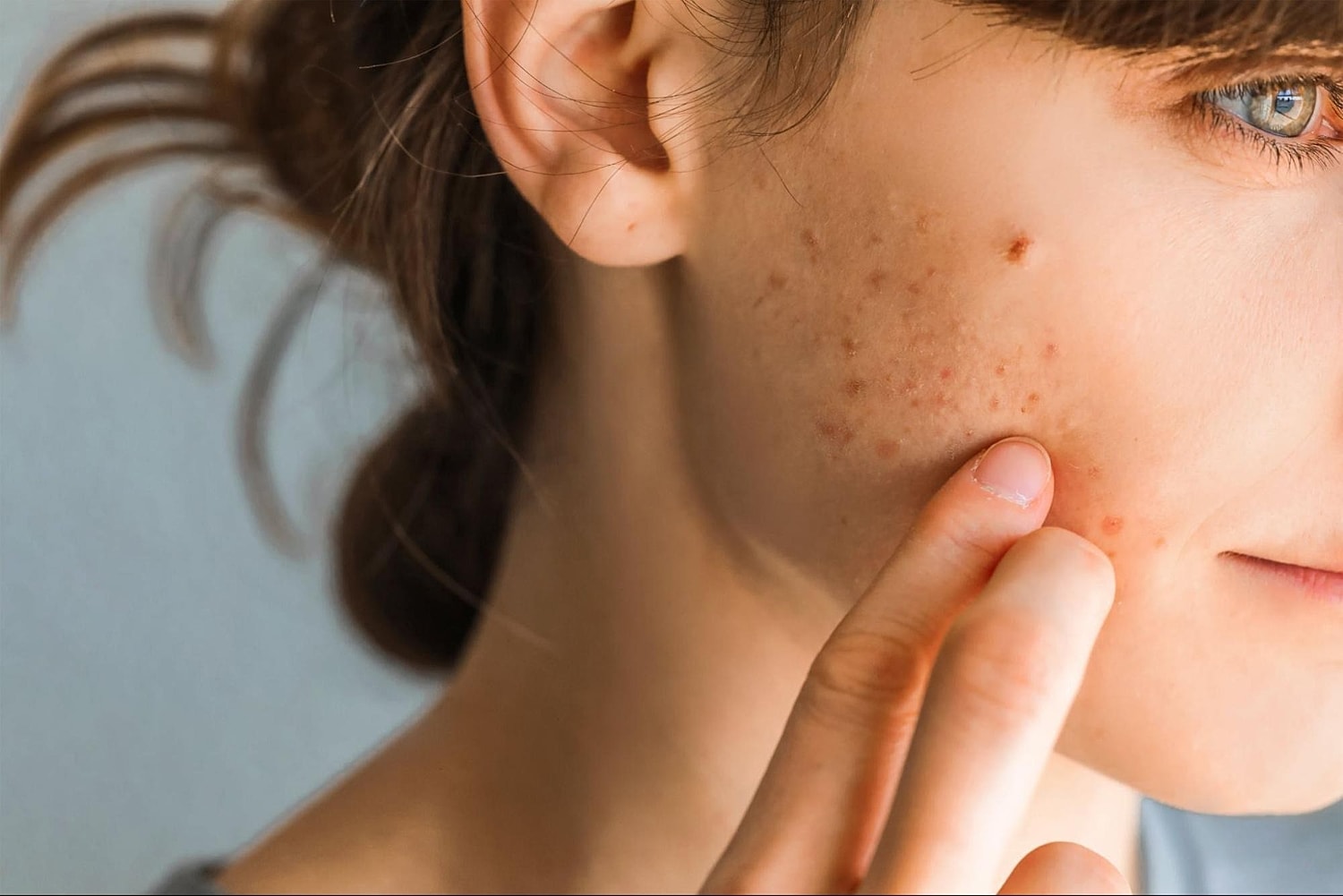 Personalized Acne Treatment Plans: Customizing Solutions for Different Skin Types