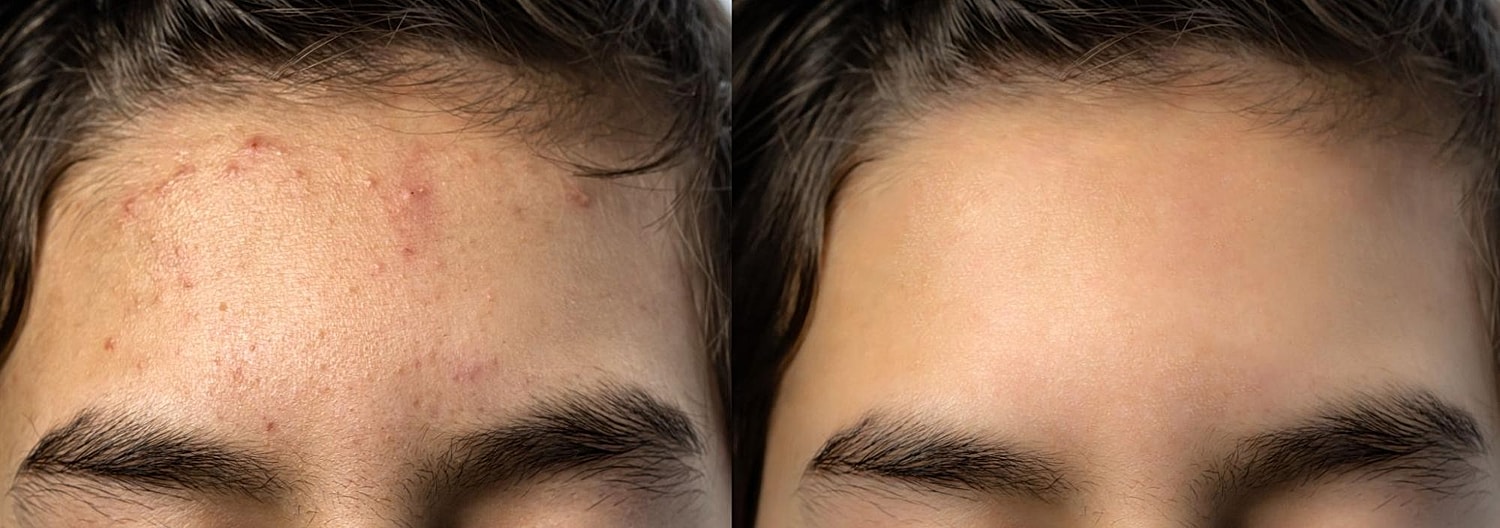 Personalized Acne Treatment Plans: Customizing Solutions for Different Skin Types