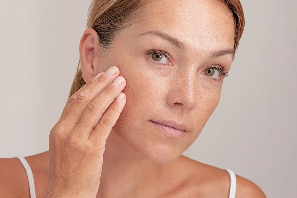 Woman showing pigmentation spots before Halo laser.