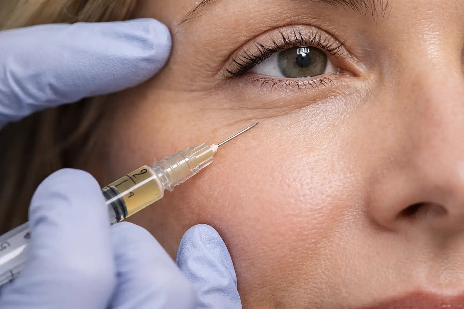 Close-up of a syringe near the under-eye area with gloved hands gently holding the skin