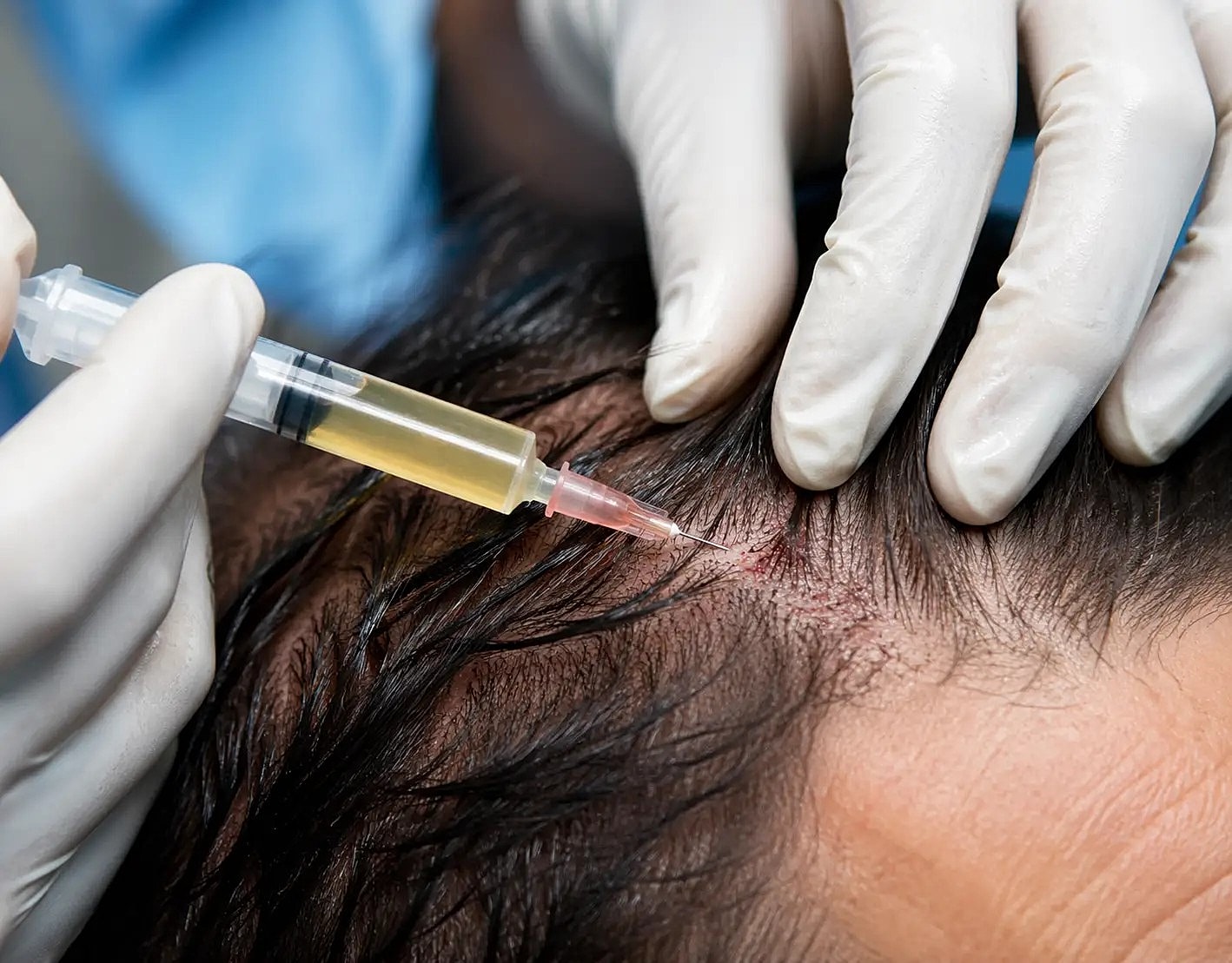 Gloved hands injecting scalp with syringe during hair treatment