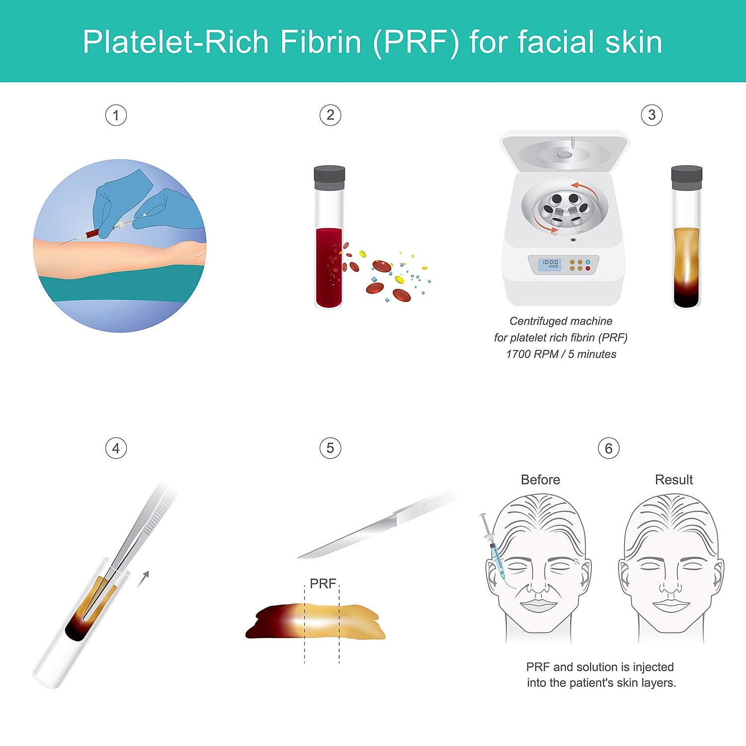 illustrated steps showing blood draw, centrifuge, and PRF injection into the skin for facial treatment