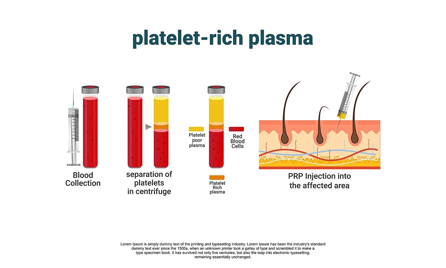 labeled diagram showing PRP preparation from blood collection, centrifugation, and injection into the skin near hair follicles