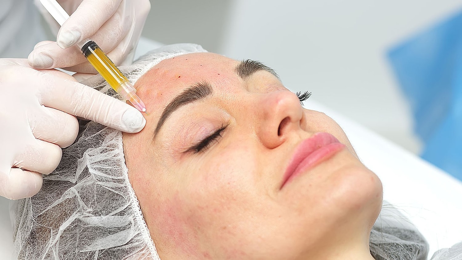 close-up of a woman lying on a treatment bed with a professional injecting PRP solution into her forehead