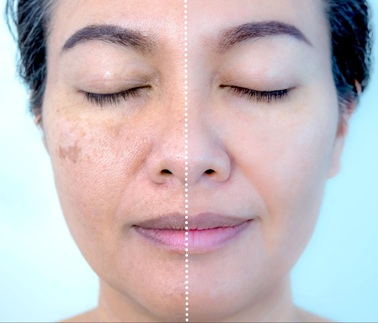 Reversing Sun Damage: Effective Treatments for Post-Summer Skin