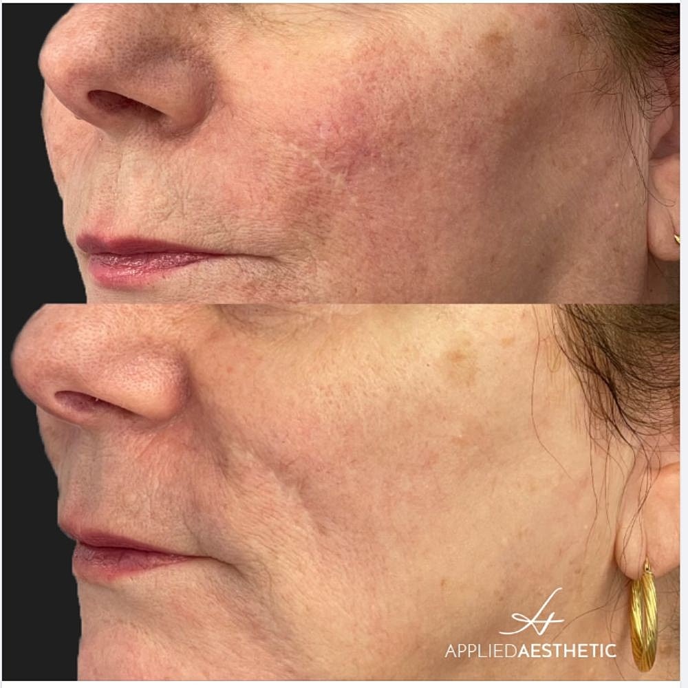 Rosacea Treatment