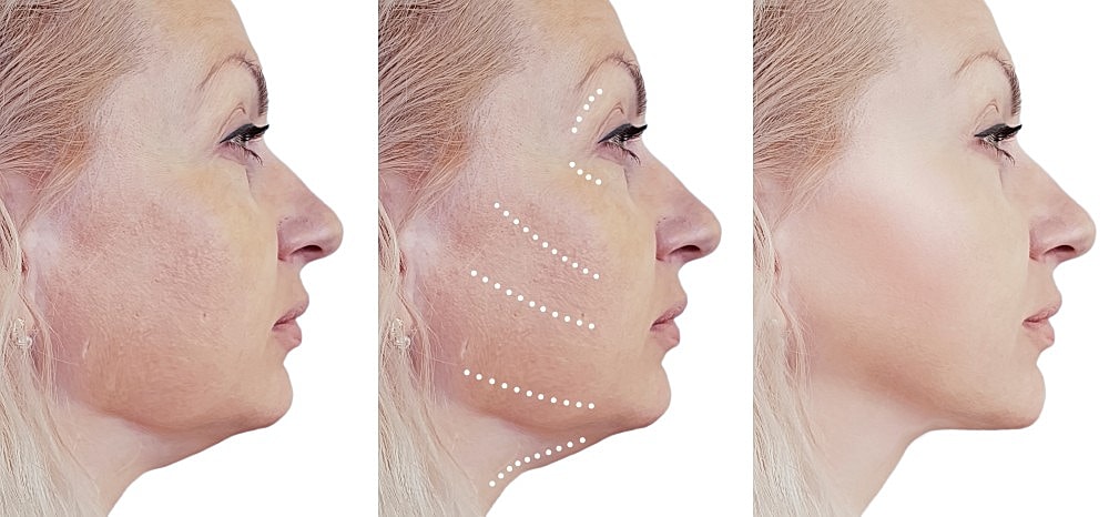 Say Bye Bye to Your Double Chin With Kybella