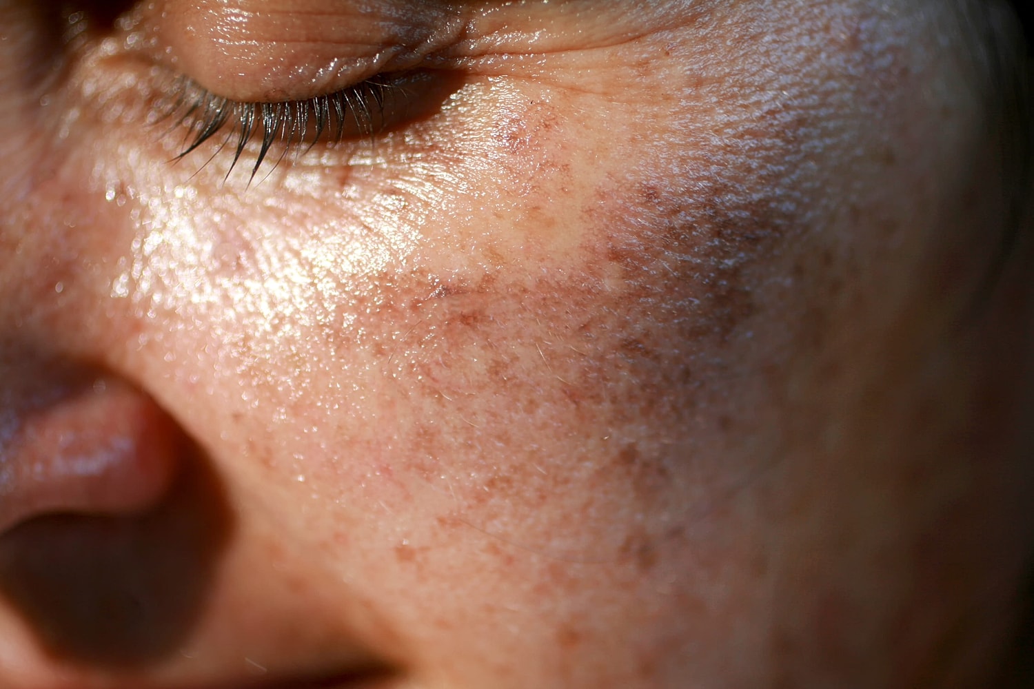 Sun Damage & Age Spot Removal in Long Island
