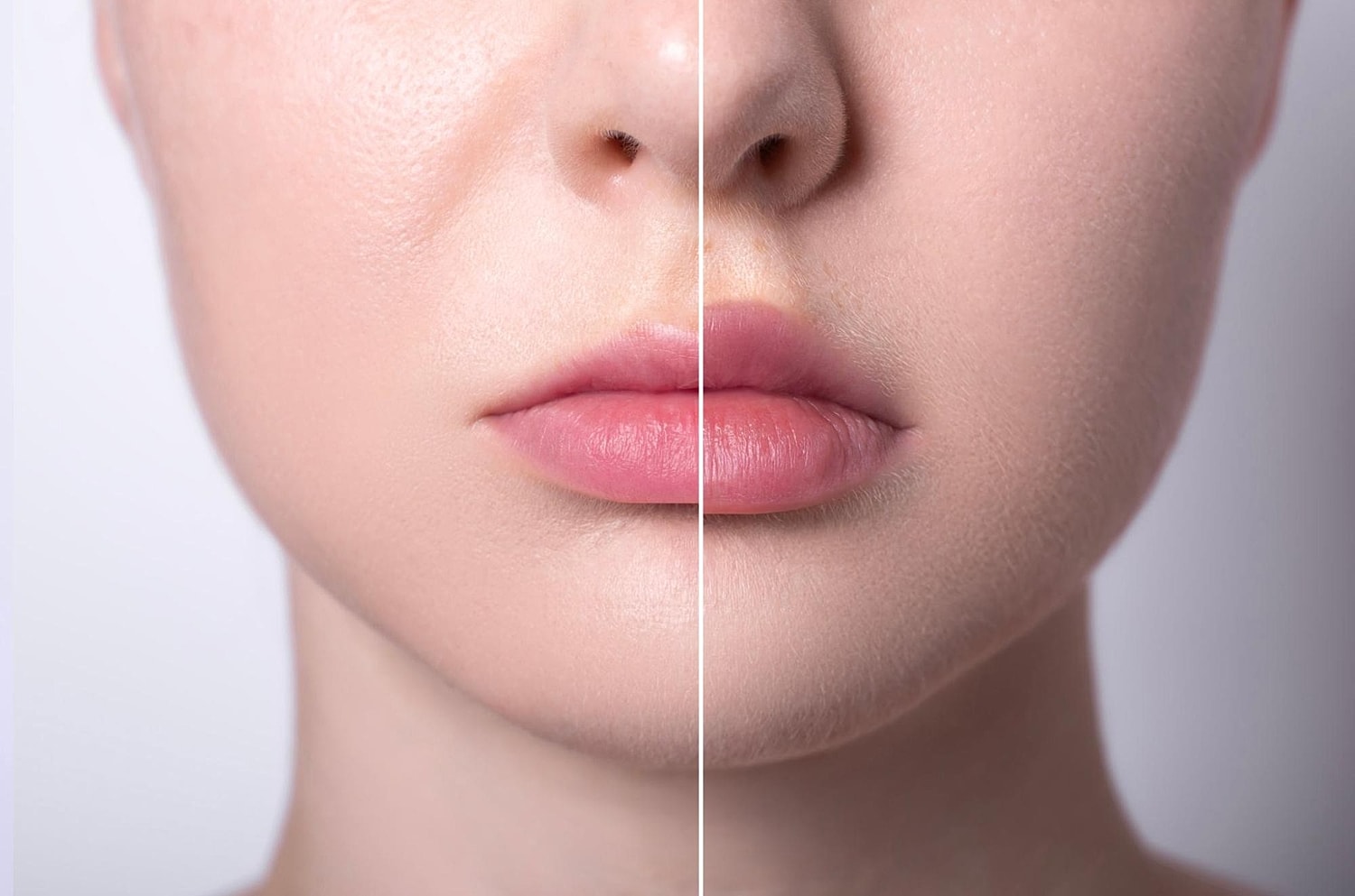 The Benefits of Customized Lip Filler Treatments - Image 2