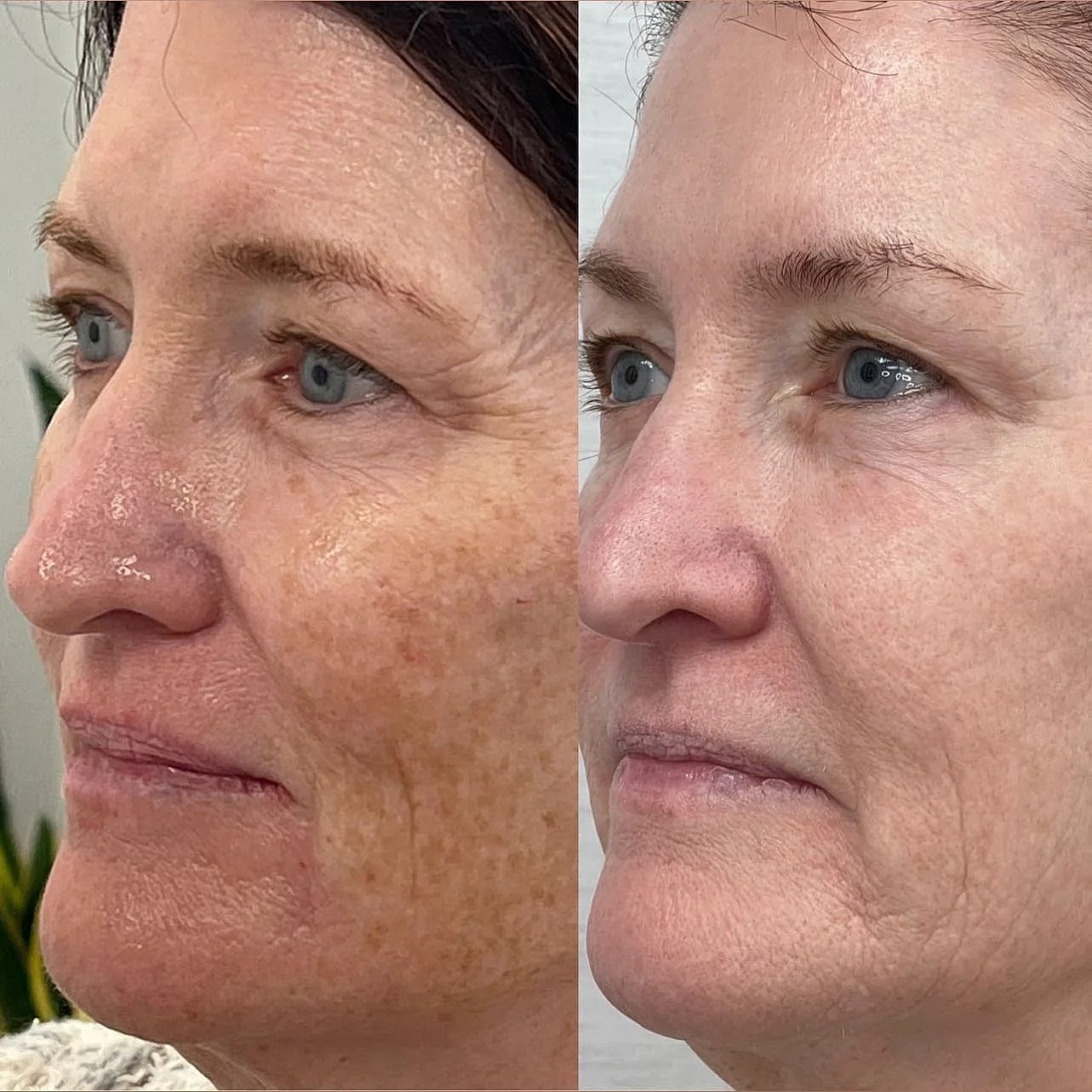 The Best MedSpa Treatments to Consider This 2024