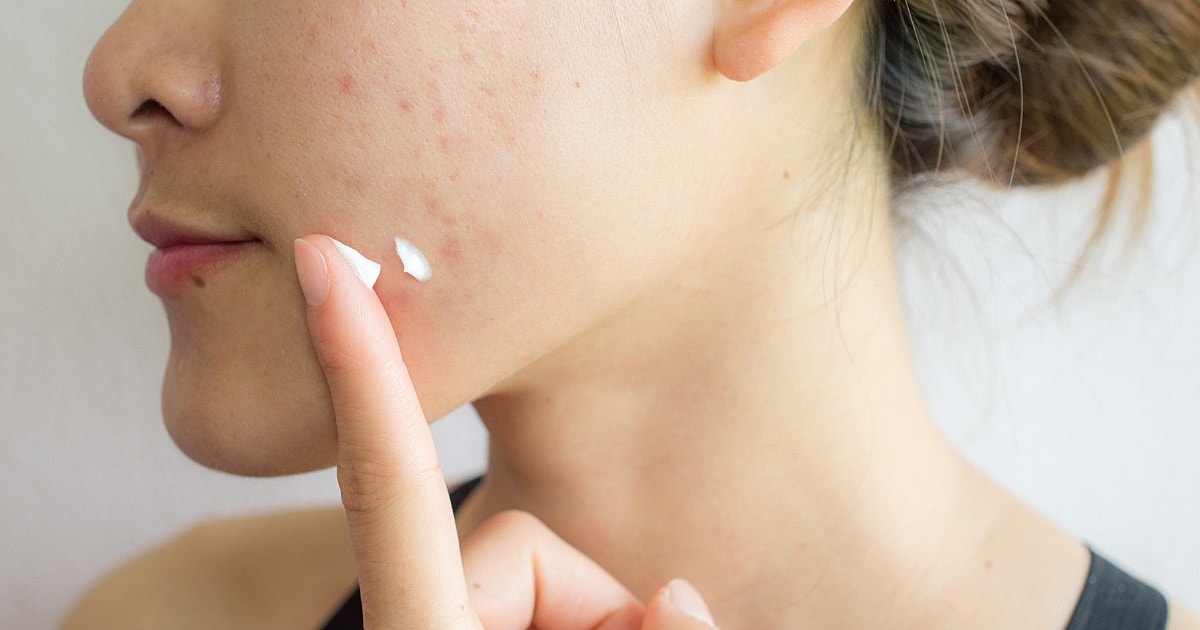 Understanding the Relationship Between Acne and Dry Skin