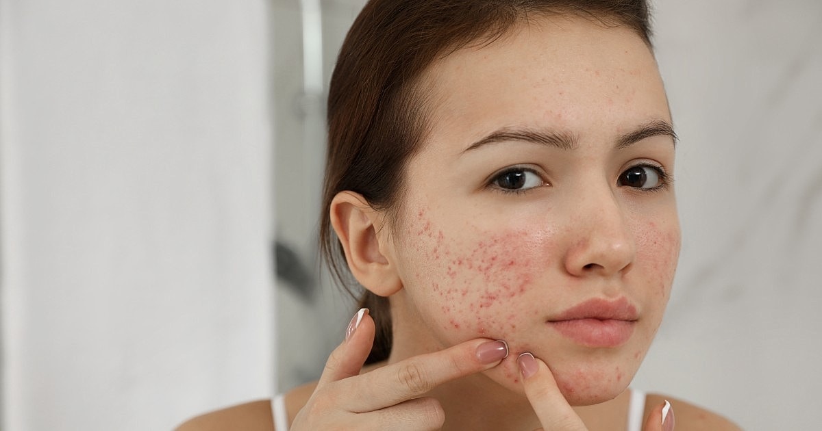 Understanding the Relationship Between Acne and Dry Skin
