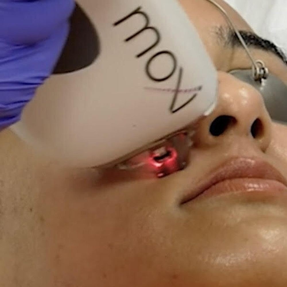 What Is MOXI Laser? The Gentle Resurfacing Everyone’s Asking About