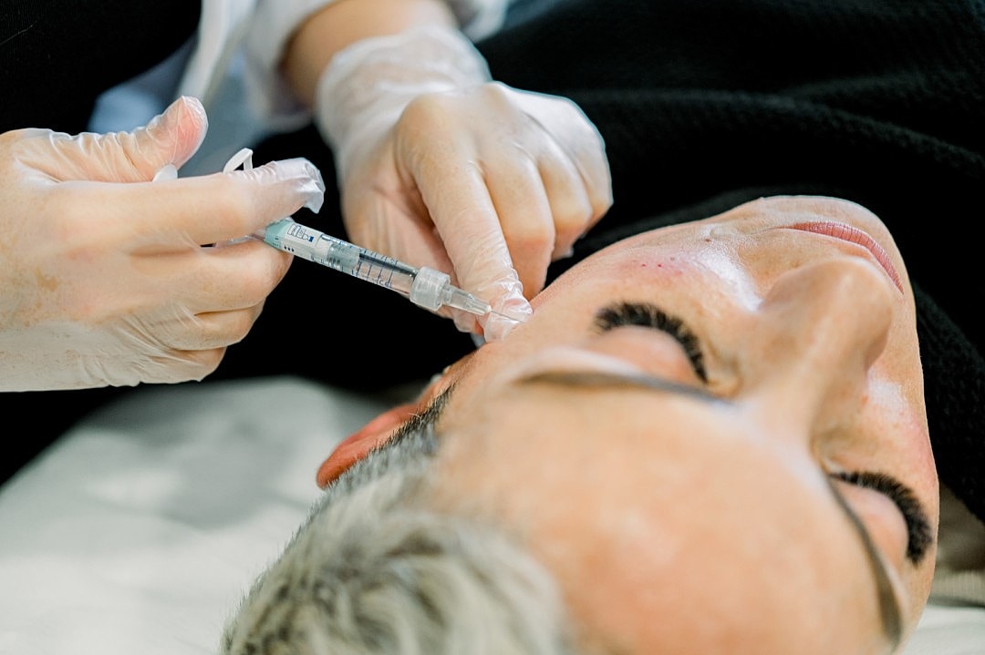 A patient receiving a Sculptra injection for facial rejuvenation.