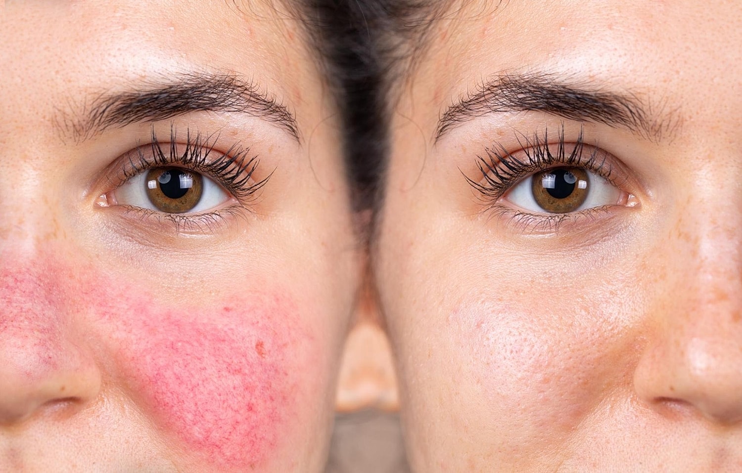What’s Rosacea and How Can BroadBand Light Treatment Improve It?
