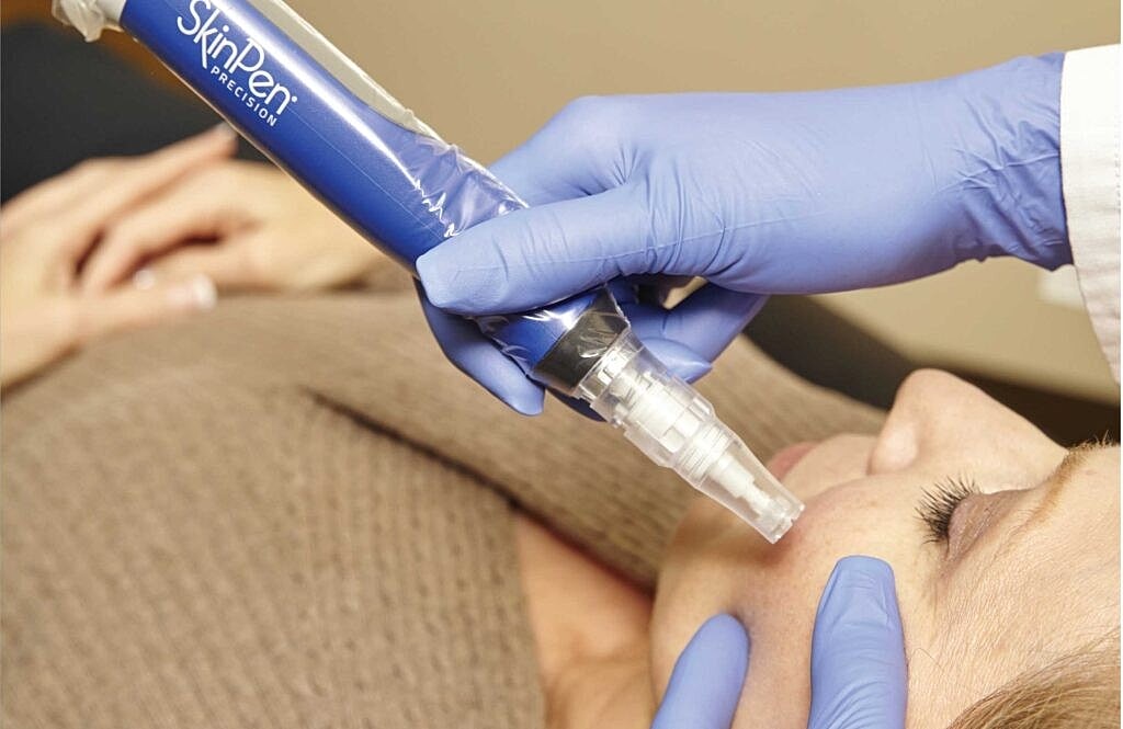 Will SkinPen Help Get Rid of Stretch Marks?
