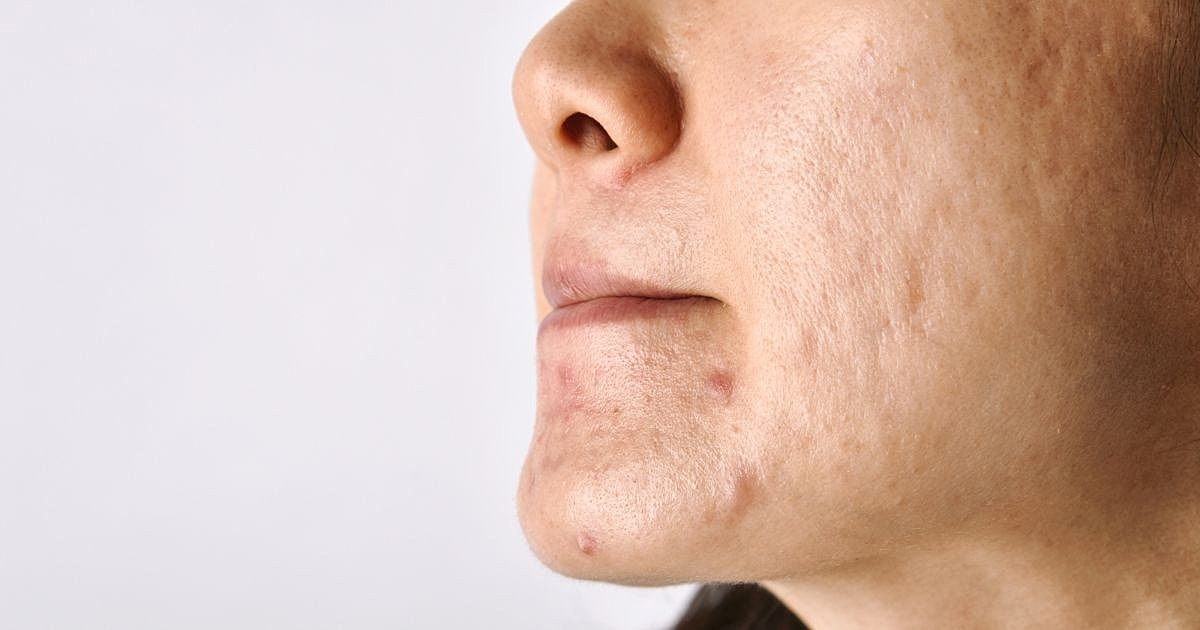 Will SkinPen Help Get Rid of Stretch Marks?