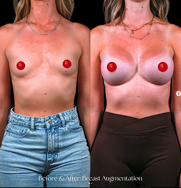 Before and after breast augmentation in Denver.
