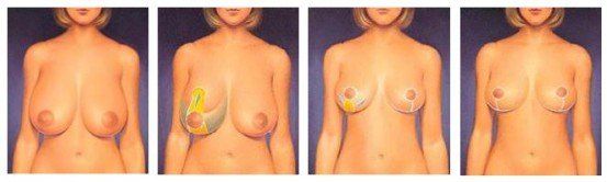 Anatomical illustration of breast surgery procedures.